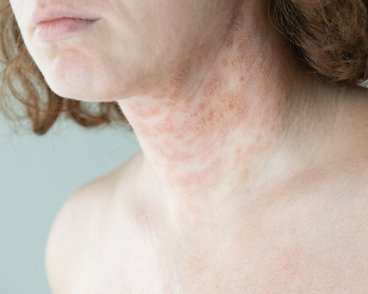 We take a look at seaweed in our skincare can help with eczema