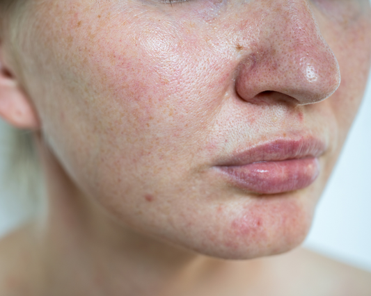 Next stop we are looking at how seaweed can help with Rosacea