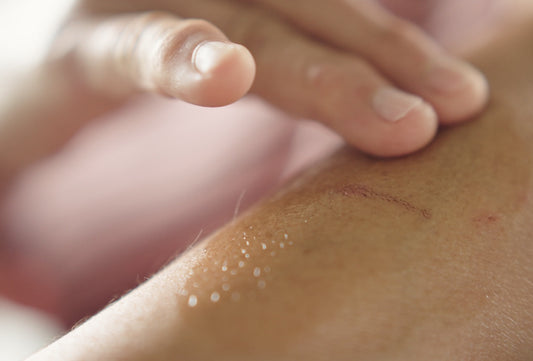 Our Rescue Balm for Scarring